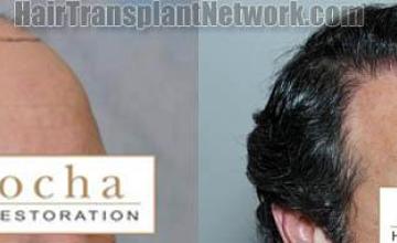 Hair transplantation surgery before and after images