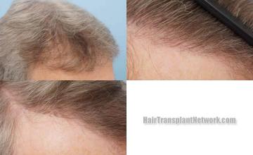 Hair transplantation surgery before and after photos