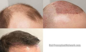 Hair restoration procedure before and after result images