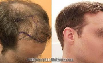 Hair transplantation procedure before and after results