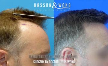 Hair restoration procedure after result images