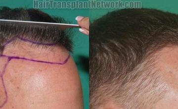 Hair restoration procedure before and after results