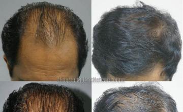 Before and after  with Finasteride