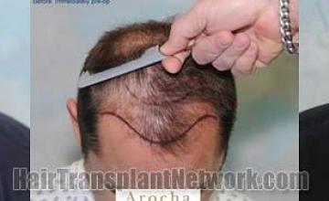 Top view - Before and after surgical hair replacement