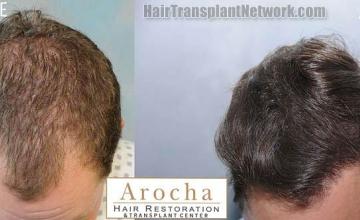 Hair transplantation surgery before and after pictures