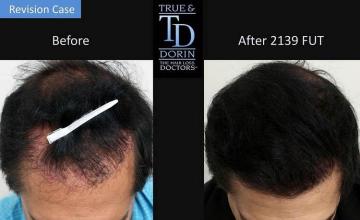 Top view before and after hair restoration results