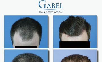 Hair transplantation surgery before and after images