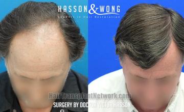 Hair transplantation surgery before and after images