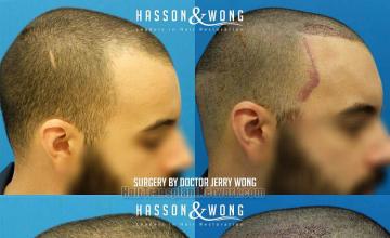 Hair restoration procedure before and after result images