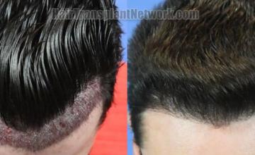 Top view - Before and after hair restoration results