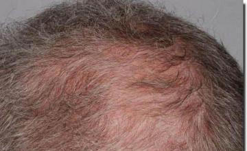 Hair restoration procedure results