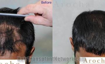 Hair transplantation surgery before and after photos