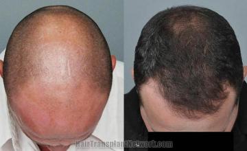 Hair transplantation surgery before and after photos