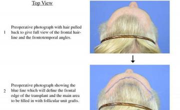 Hair transplantation surgery before and after photos