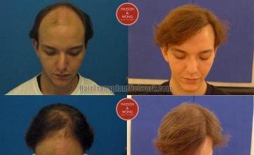 Top view before and after hair restoration results