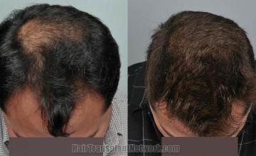 Hair transplantation surgery before and after images