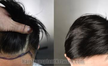 Top view - Before and after hair restoration results