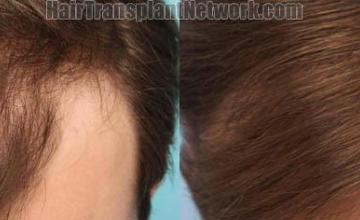 Hair transplantation surgery before and after photos