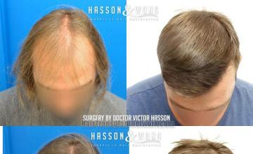 Hair transplantation surgery before and after images