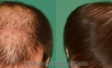 Top view - Before and after surgical hair replacement