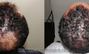  before and after result photographs