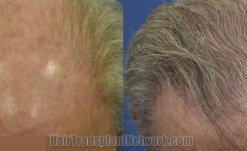 Top view - Before and after hair restoration results