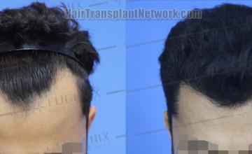 Top view - Before and after hair restoration results