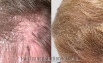 Top view - Before and after hair restoration results