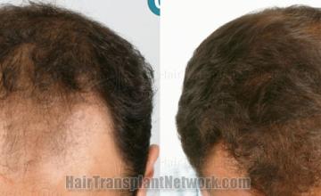 Top view - Before and after hair restoration results