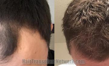 Top view - Before and after hair restoration results