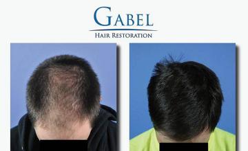 Hair transplantation surgery before and after images