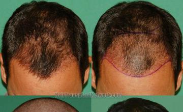 Hair transplantation surgery before and after images