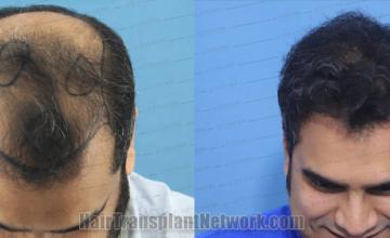  before and after result photographs