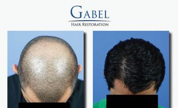 Hair transplantation surgery before and after images