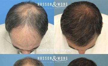 Hair transplantation surgery before and after photos