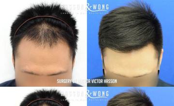 Hair transplantation surgery before and after images