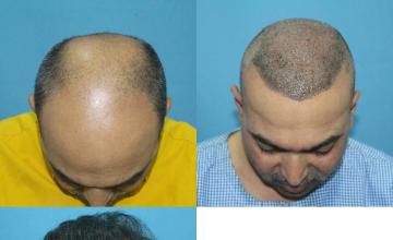 Hair transplantation surgery before and after images