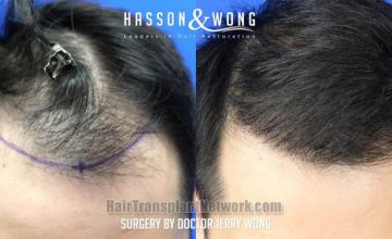 Hair transplantation surgery before and after images