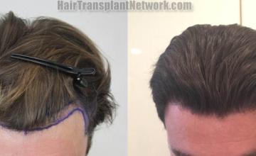 Hair transplantation surgery before and after images