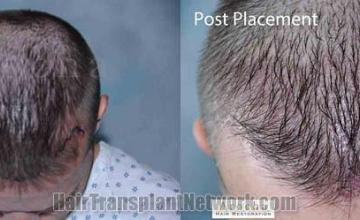 Hair transplantation surgery before and after photos