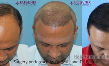 Before and after hair restoration procedure images