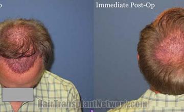 Surgical hair transplantation result photographs