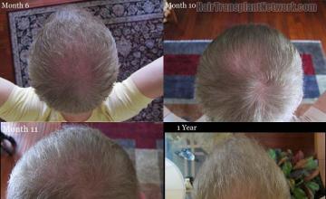 Hair transplantation surgery before and after pictures