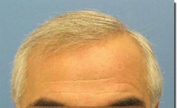 Hair restoration procedure results