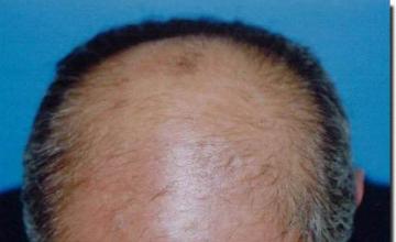 Hair restoration procedure results