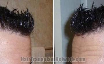 Hair transplantation surgery before and after pictures