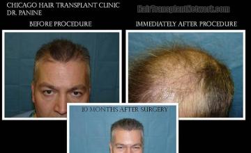 Hair restoration procedure before and after results