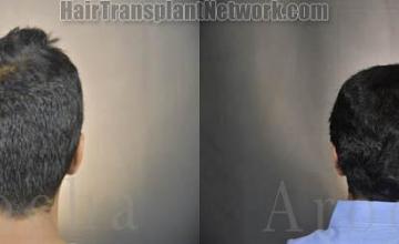 Surgical hair transplantation result photographs