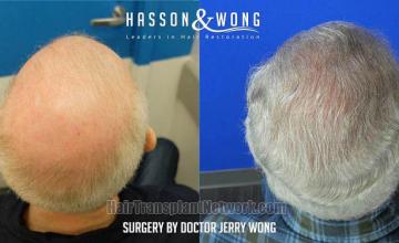 Hair restoration procedure before and after result images