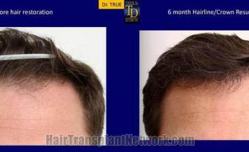 Front view - Before and after  
